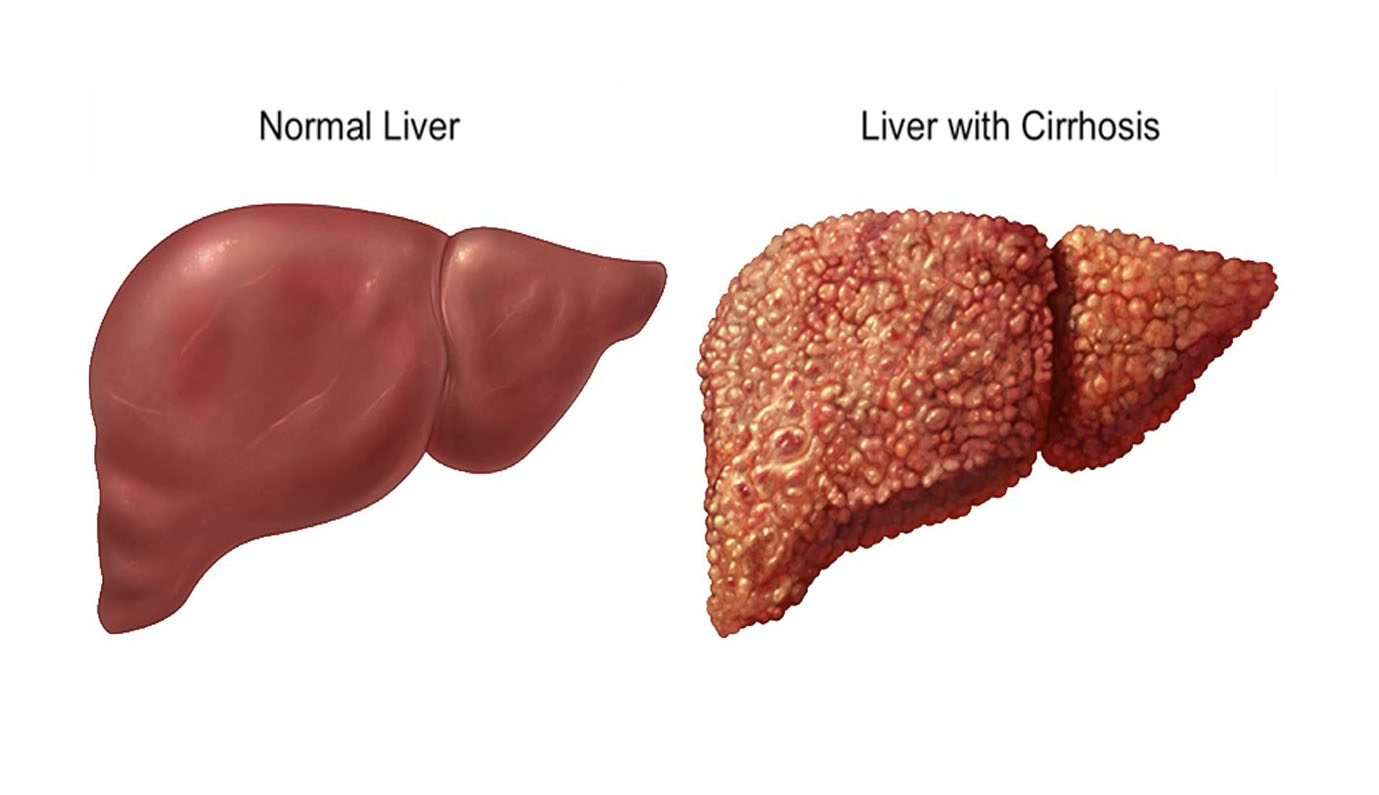liver cirrhosis - کبد چرب؛ علل ایجاد آن، علائم و راه های درمان کبد چرب