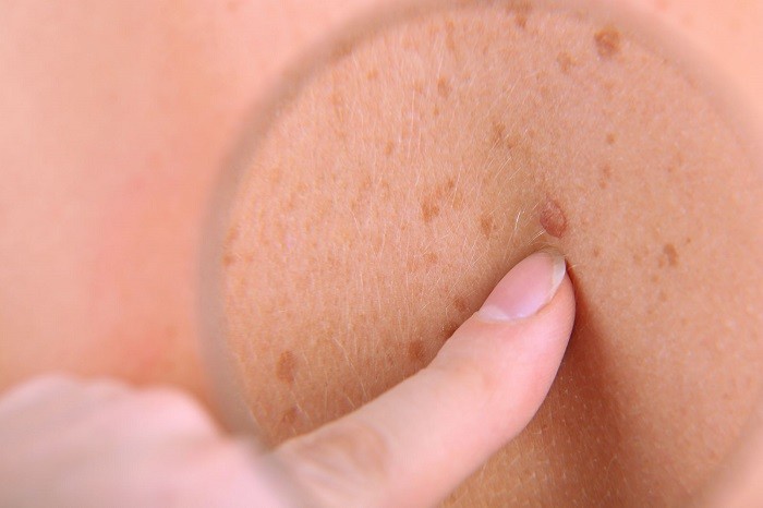 سرطان پوست - علائم هشداردهنده سرطان که باید آنها را جدی بگیریم