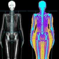 خطرات اشعه ایکس برای مبتلایان به چاقی